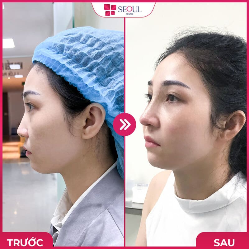 Khách Hàng Nâng Mũi Tại Seoul Center Đà Nẵng