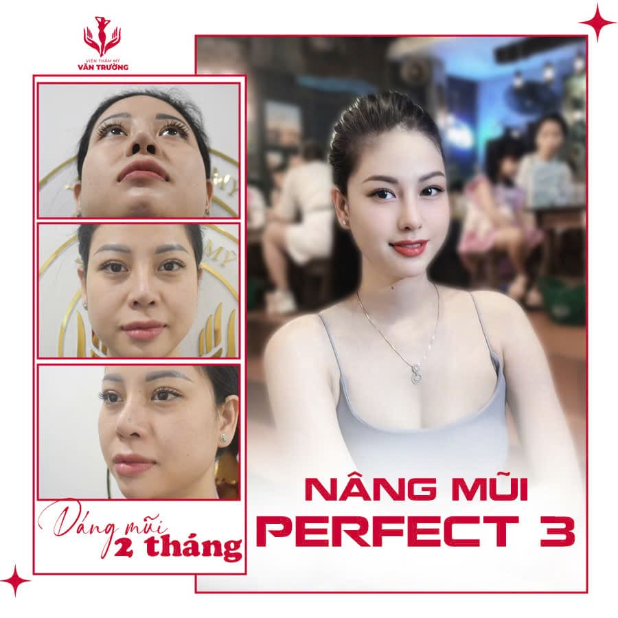 Khách Hàng Sau Khi Nâng Mũi Perfect 3 Tại TMV Văn Trường Đà Nẵng