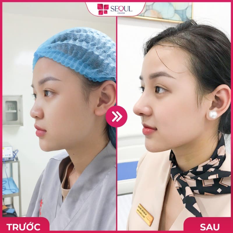 Khách Hàng Nâng Mũi Tại Seoul Center